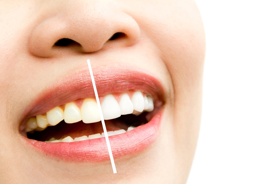 best online teeth whitening kits